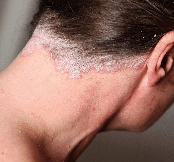 Hogyan kell kezelni a psoriasist