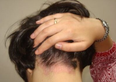 Psoriasis a fején