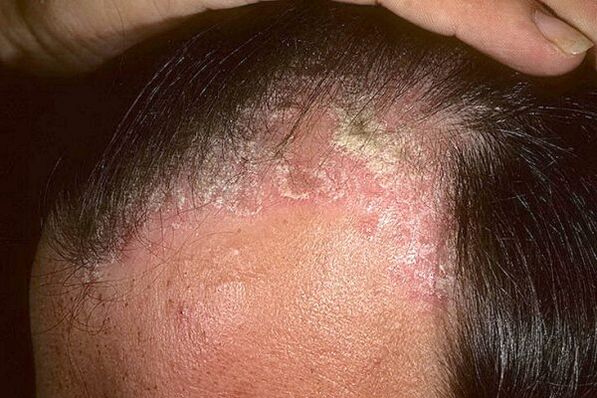 Psoriasis tünetek