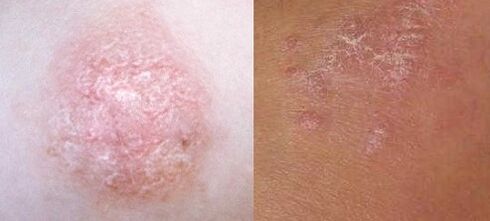 Psoriasis a kezdeti szakaszban